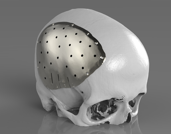 두개골 맞춤형 임플란트 이미지